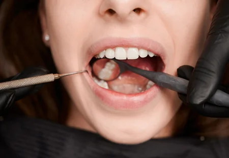 Wisdom Tooth Extraction at Vasavi Hospitals