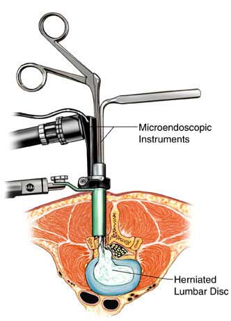 Microendoscopic instruments used for herniated lumbar disc treatment at Vasavi Hospitals Bangalore.