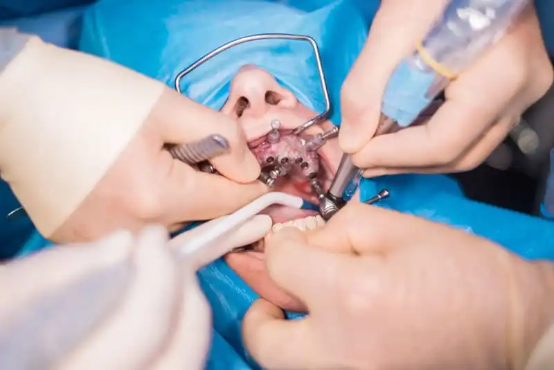 Oral and maxillofacial surgery procedure at Vasavi Hospitals Bangalore
