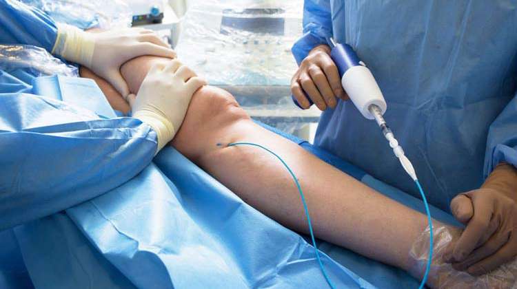 Vascular surgeon performing leg surgery for vein treatment at Vasavi Hospitals Bangalore